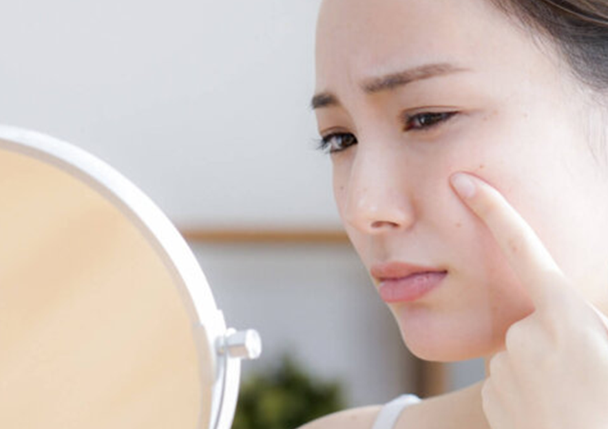 5 Types Of Acne Scars And What Causes Them
