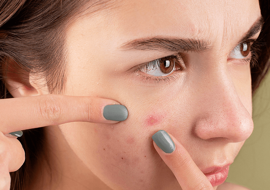 Acne Glossary: Key Skincare Terms Decoded