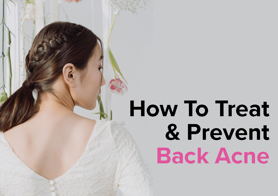 How To Prevent & Treat Back Acne (“Bacne”)